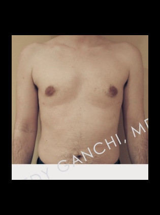 Gynecomastia New Jersey  Male Breast Reduction Bergen County