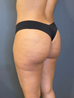 Patient 119942195, Brazilian Butt Lift (BBL) Before & After Photos