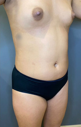 Liposuction