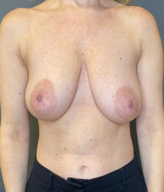 Breast Lift