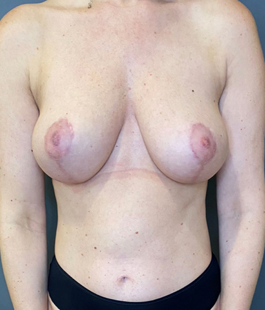 Breast Lift