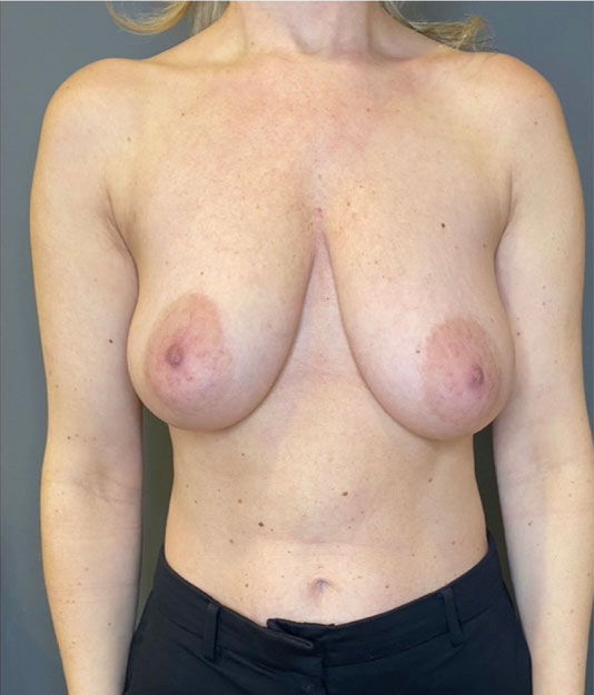 Breast Lift