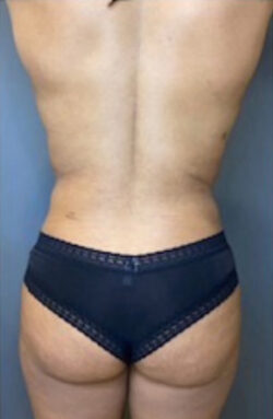 Liposuction