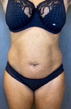 Liposuction