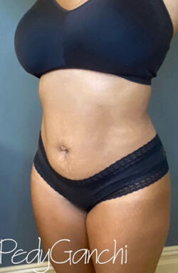 Liposuction