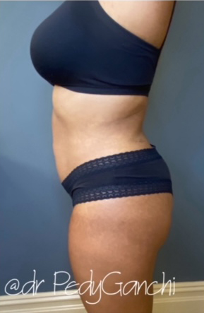 Liposuction