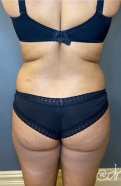 Liposuction