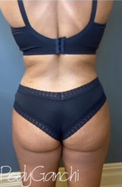 Liposuction