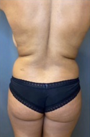 Liposuction