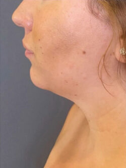 Chin Augmentation - Neck Liposuction