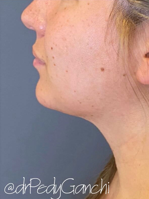 Chin Augmentation - Neck Liposuction