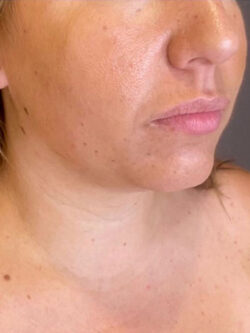 Chin Augmentation - Neck Liposuction