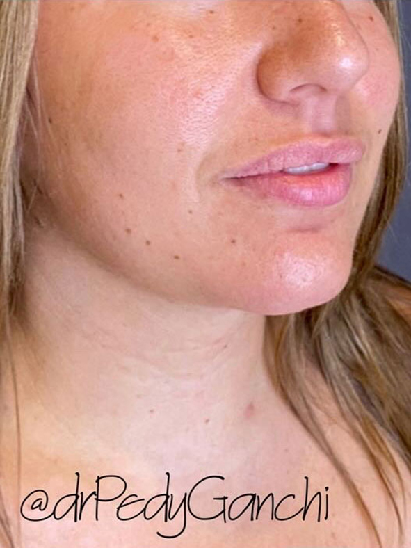 Chin Augmentation - Neck Liposuction