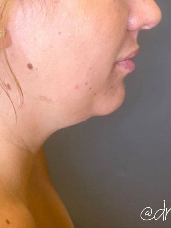 Chin Augmentation - Neck Liposuction