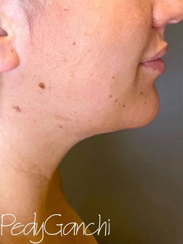 Chin Augmentation - Neck Liposuction