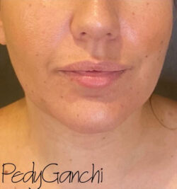 Chin Augmentation - Neck Liposuction