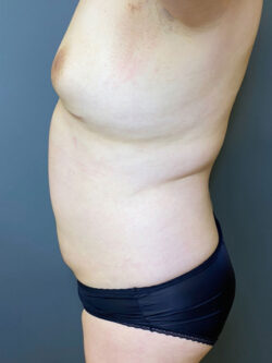 Liposuction