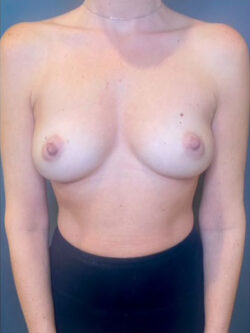 Breast Augmentation (Implants)